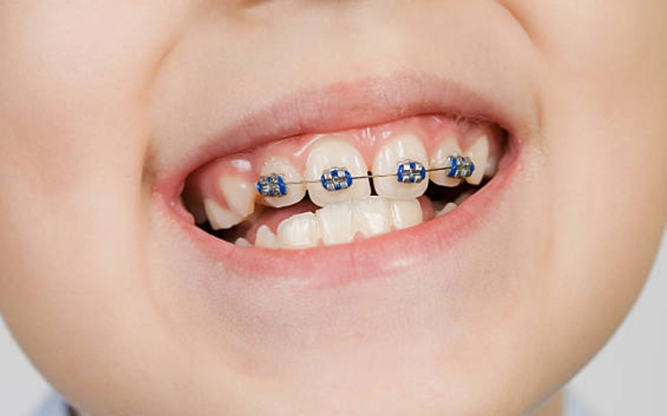 Partial braces