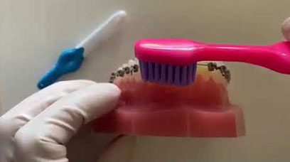 How to Brush your teeth with Braces