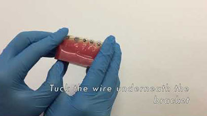 Long wire or poking wire with braces