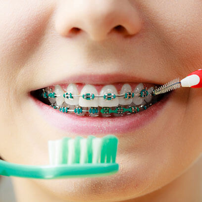How to fix your braces How to fix your braces