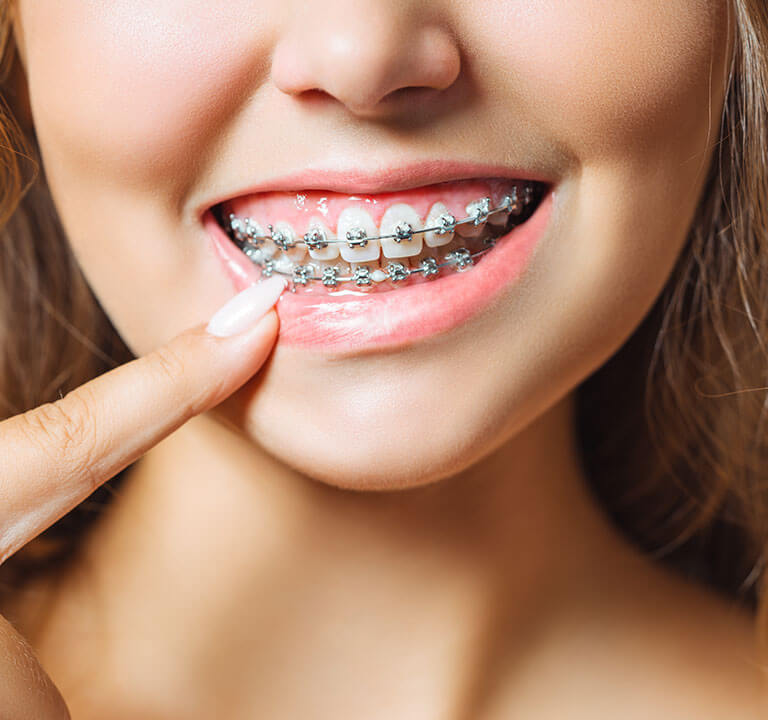 How do braces work?