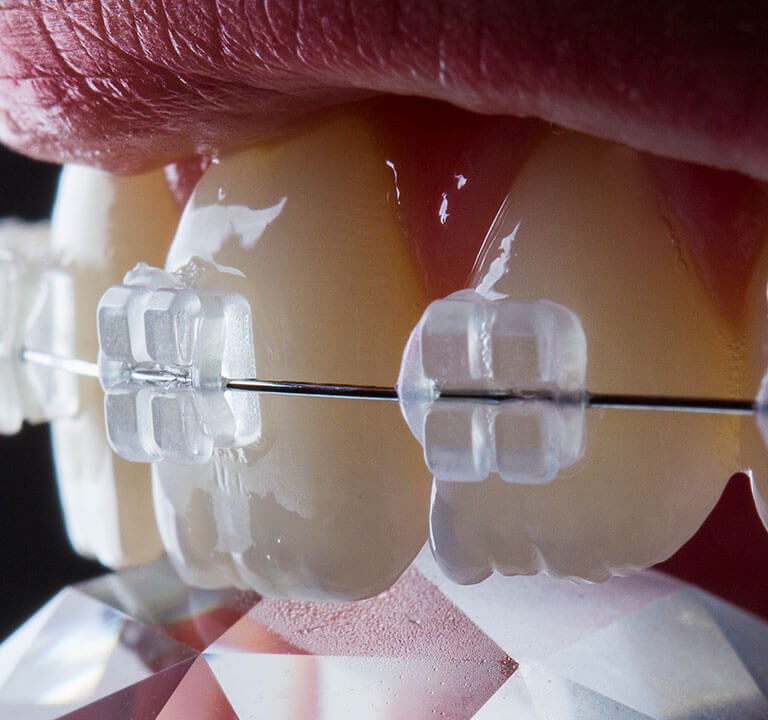 Ceramic braces