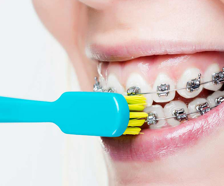 Cleaning your teeth with braces