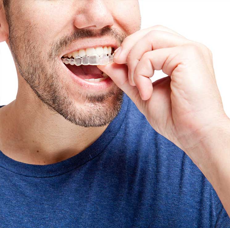 Invisalign types