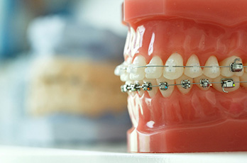 Types of braces