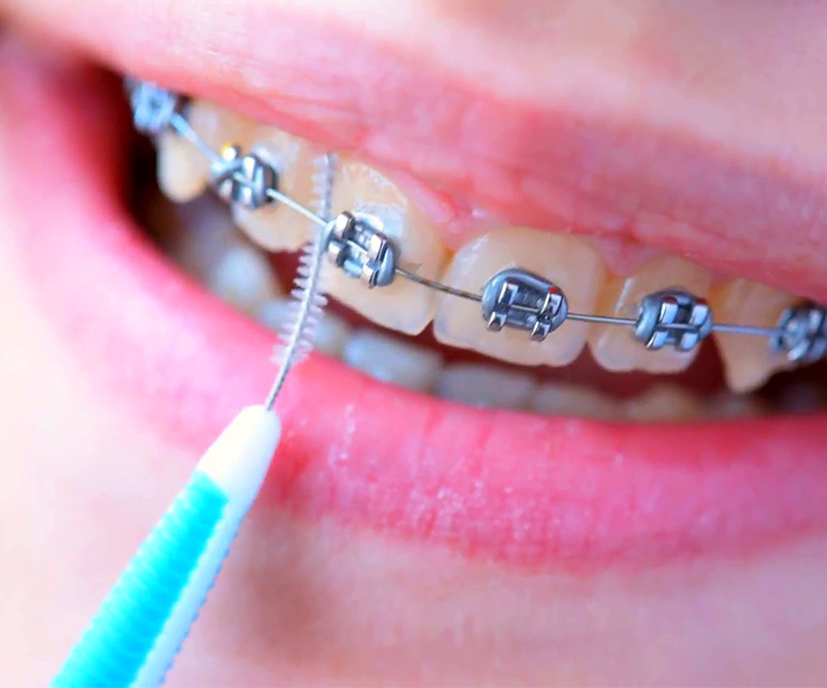 Cleaning your teeth with braces